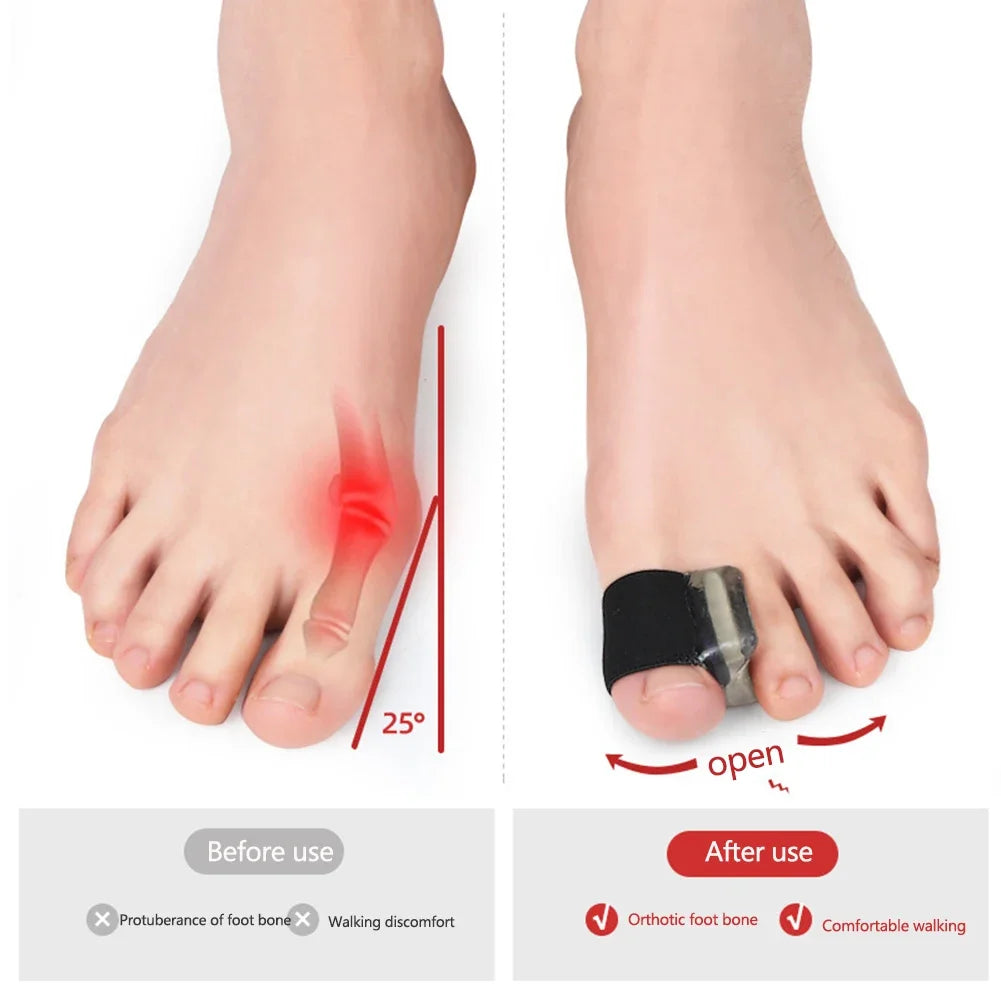 Silicone Bunion Corrector – Hallux Valgus Toe Straightener
