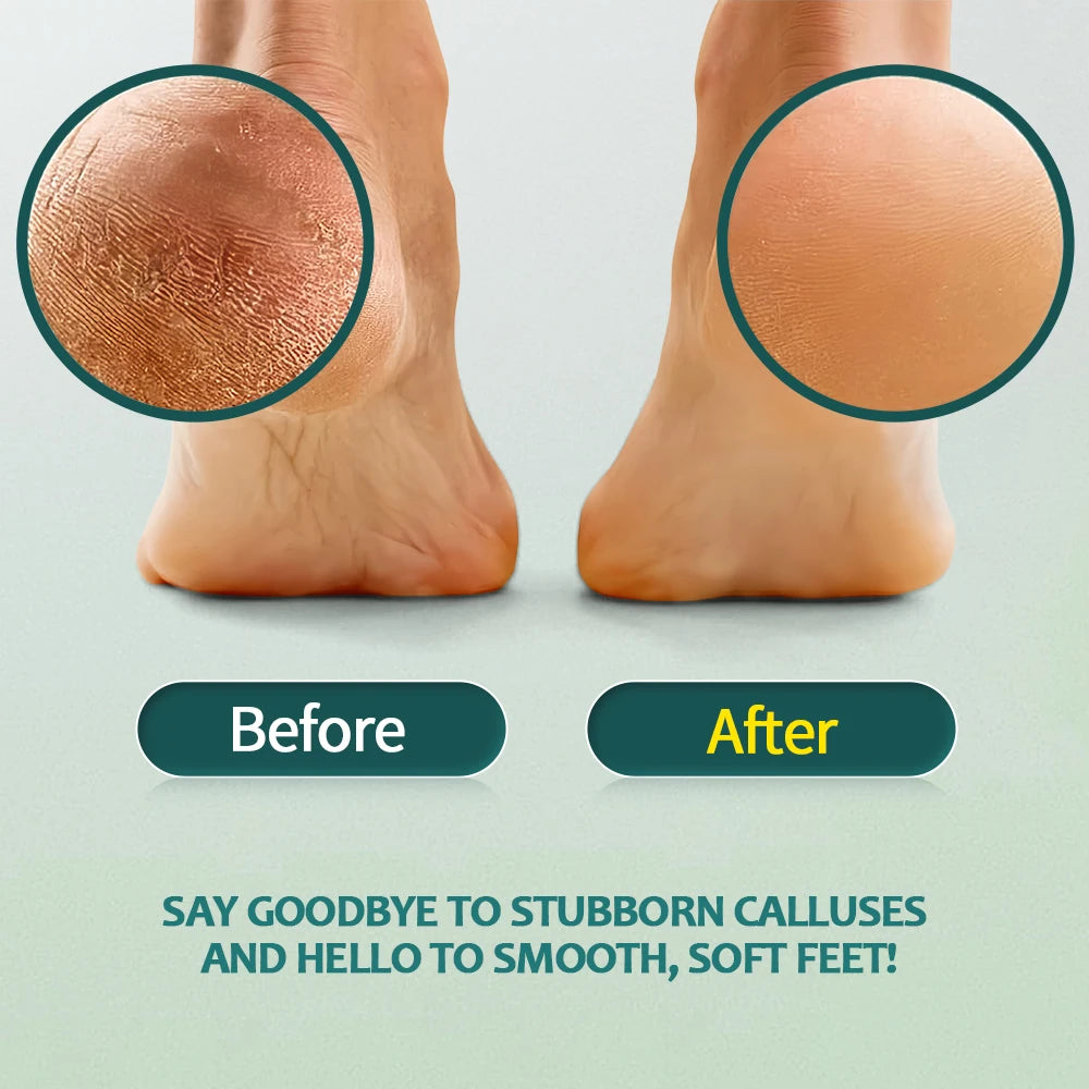 Nailpop Professional Callus Remover – Extra Strength Gel & Rasp Foot File Kit for Dead Skin & Cracked Heels