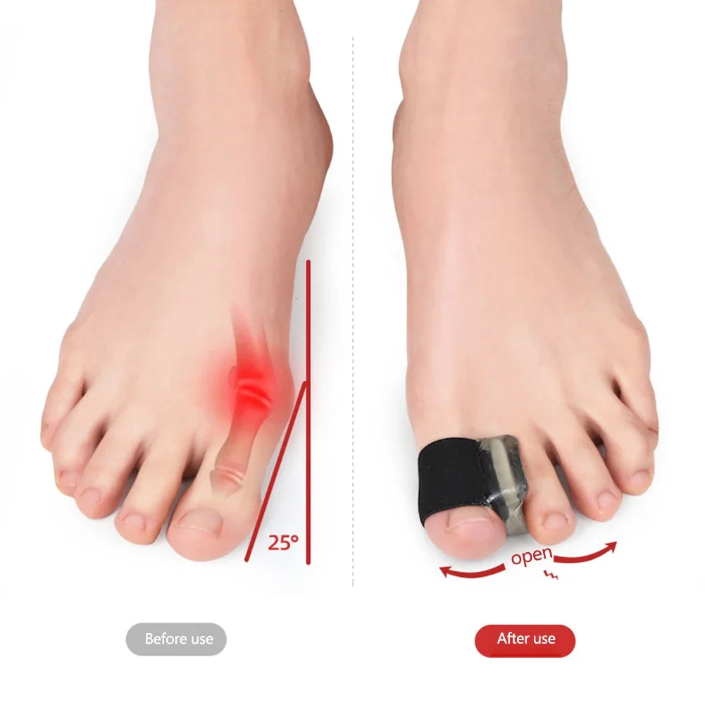 Silicone Bunion Corrector – Hallux Valgus Toe Straightener